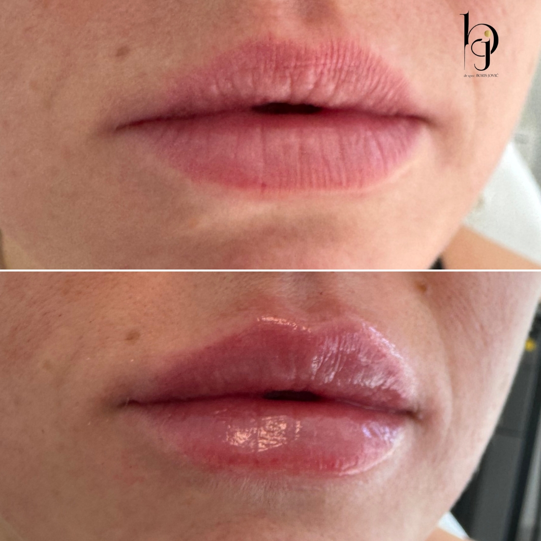 LIPS - hyaluronic fillers